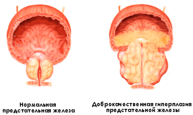 Гиперплазия предстательной железы