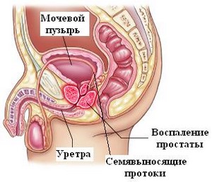 воспаление предстательной железы