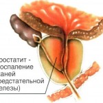 Можно ли вылечить хронический простатит